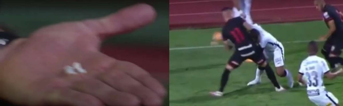 Nietypowa sytuacja w meczu ligi brazylijskiej! Piłkarz stracił cztery zęby [WIDEO] Zdjęcie główne wpisu