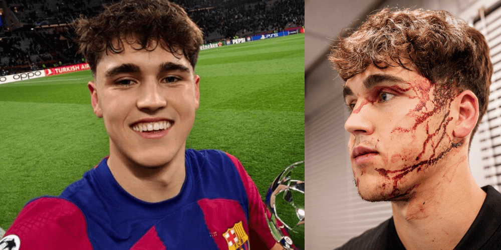 Tak wyglądał Pau Cubarsi po meczu z Crveną Zvezdą. Hiszpanowi założono dziesięć szwów Zdjęcie główne wpisu