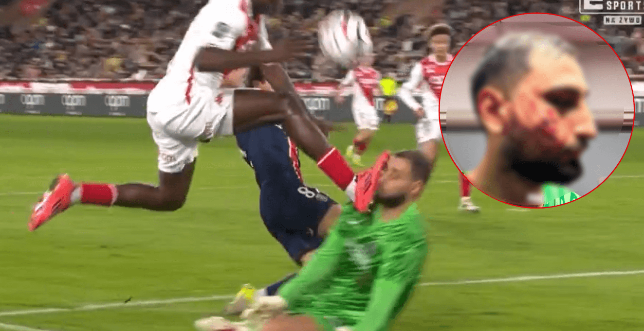 Tak wygląda twarz Donnarummy po fatalnej kontuzji. Boli od samego patrzenia Zdjęcie główne wpisu